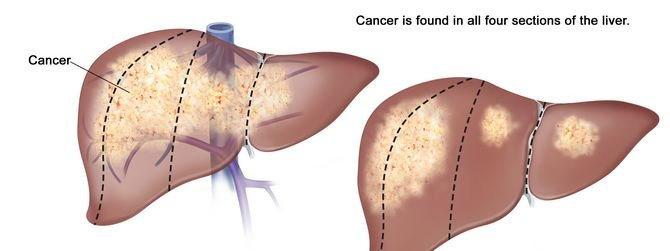 What is stage IV lymphoma?