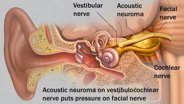 Acoustic Neuroma location