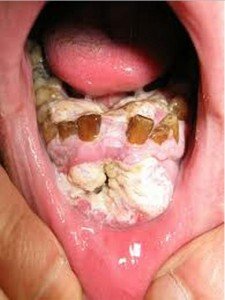 Advanced Gum Cancer Images