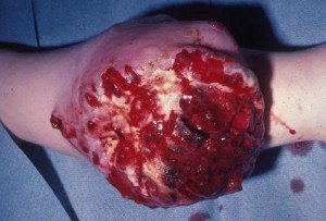 Rhabdomyosarcoma - Symptoms, Pictures, Survival Rate, Prognosis