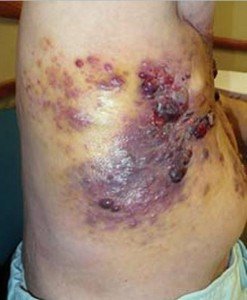 Angiosarcoma pics