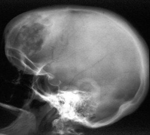 Pictures of Chondrosarcoma