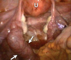 Fallopian Tube Cancer Picture