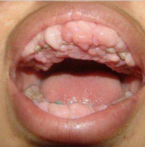 Gum Cancer Picture