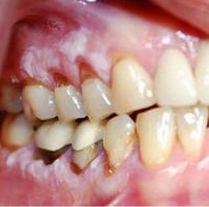 Gum Cancer Pictures