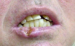 Lip Cancer picture