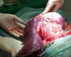 Liver Angiosarcoma Pictures