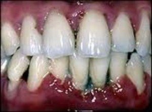 Localized Gum Cancer pics