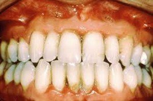 Pictures of Periodontal Gum Disease