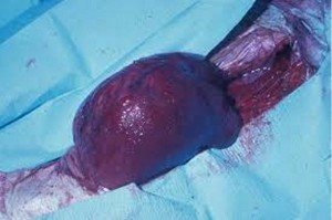 Rhabdomyosarcoma - Symptoms, Pictures, Survival Rate, Prognosis