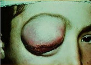 Rhabdomyosarcoma - Symptoms, Pictures, Survival Rate, Prognosis