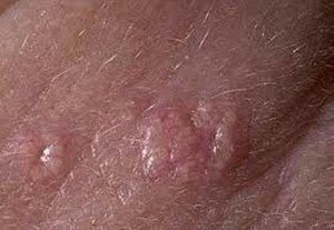 Sebaceous Adenoma pictures