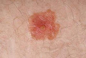 Squamous Cell Carcinoma in Situ pictures