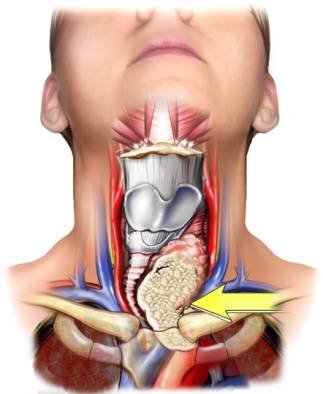 Anaplastic Thyroid Cancer image