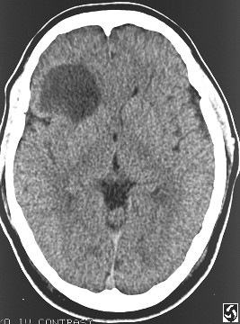 Image of Anaplastic Astrocytoma