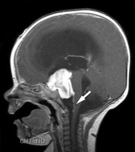 Pilocytic Astrocytoma - Prognosis, Survival Rate and Treatment ...
