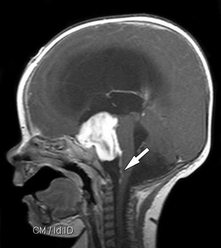 Pilocytic Astrocytoma pics