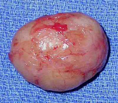 Schwannoma picture