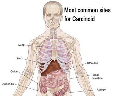 Most common sites for neuroendocrine tumor