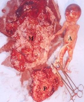 Partial Molar Pregnancy Image