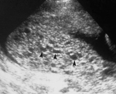 Partial molar Pregnancy ultrasound