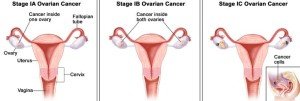 germ cell cancer (ovarian) cancer