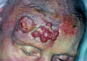 Merkel Cell Cancer Advanced Stage