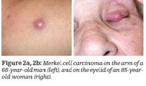 Merkel Cell Carcinoma Picture