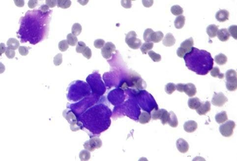 oat cell carcinoma histology