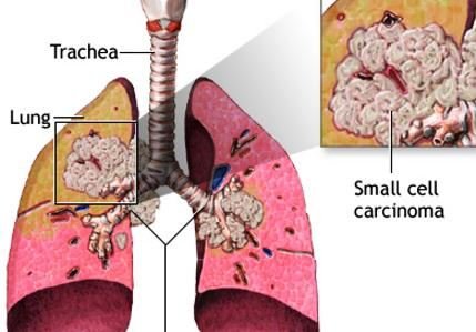 oat cell carcinoma