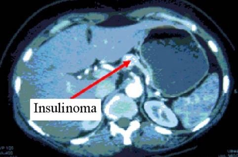 INSULINOMA CT SCAN