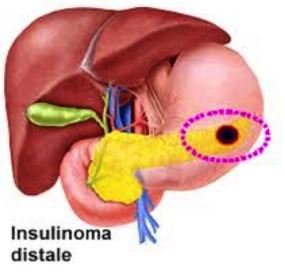 INSULINOMA