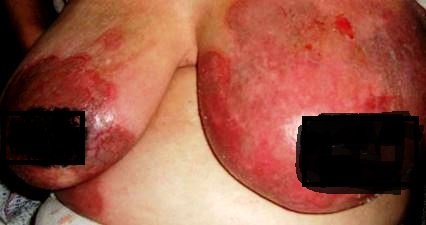 Mycosis Fungoides breast