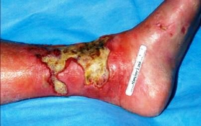 Mycosis Fungoides