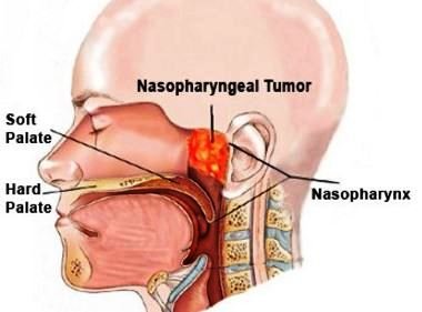 Nasopharyngeal Carcinoma