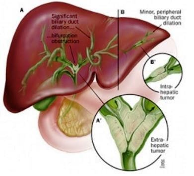 cholangiocarcinoma