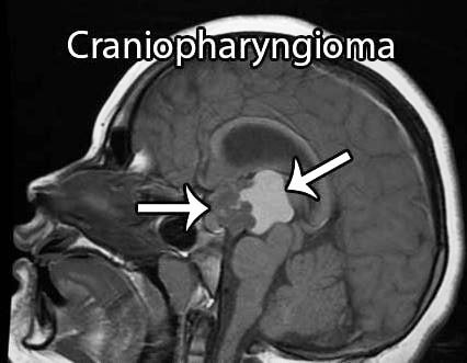 craniopharyngioma