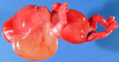 cystic hygroma image