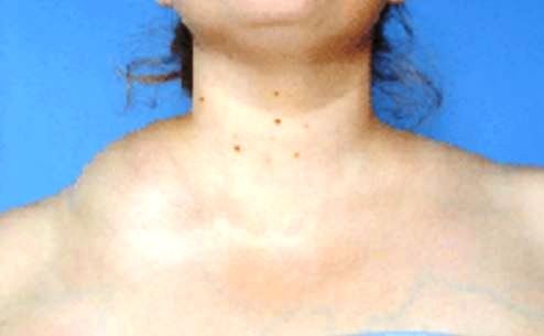 cystic hygroma near neck