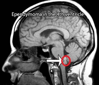 ependymoma skull