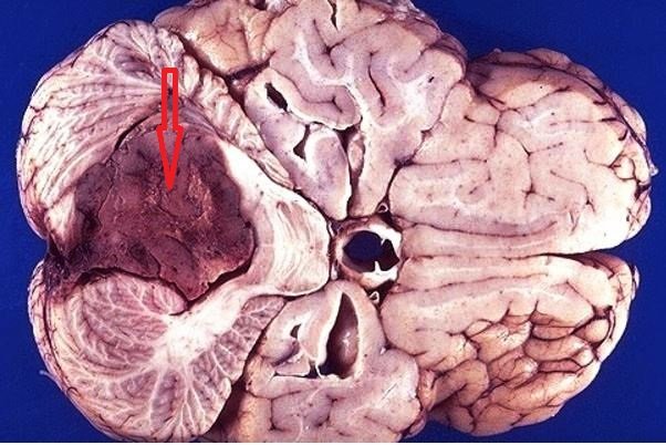 ependymoma gross (external morphology)