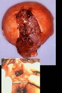 gestational trophoblastic disease image