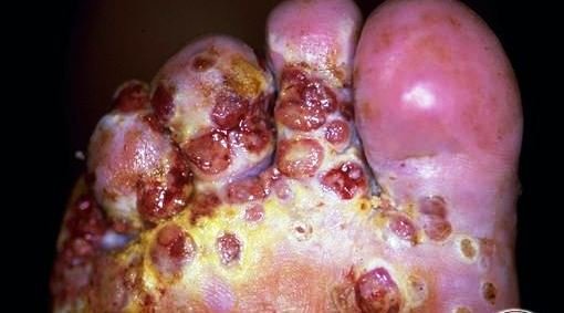 kaposi sarcoma on legs picture