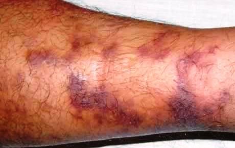 kaposi sarcoma on legs