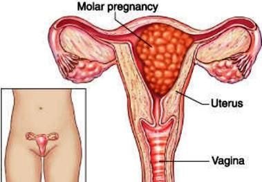 molar pregnancy