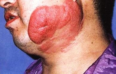 mycosis fungoides face