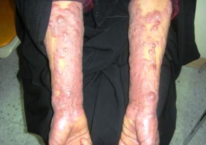 mycosis fungoides hands