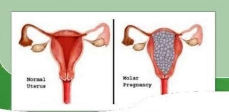 normal vs molar pregnancy