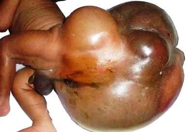 sacrococcygeal teratoma massive