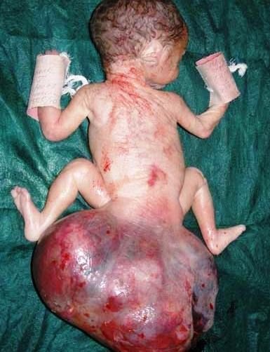 sacrococcygeal teratoma picture